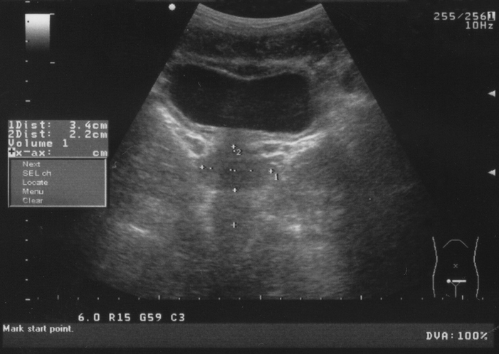Why You May Need a Full Bladder for that Ultrasound | GO Imaging